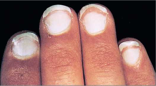 Đốm trắng trên móng tay (Leuconychia) là gì, nguyên nhân, cơ chế, ý nghĩa,  hình ảnh